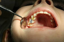 За протезирование несоответствующего качества стоматологи Первоуральска будут отвечать